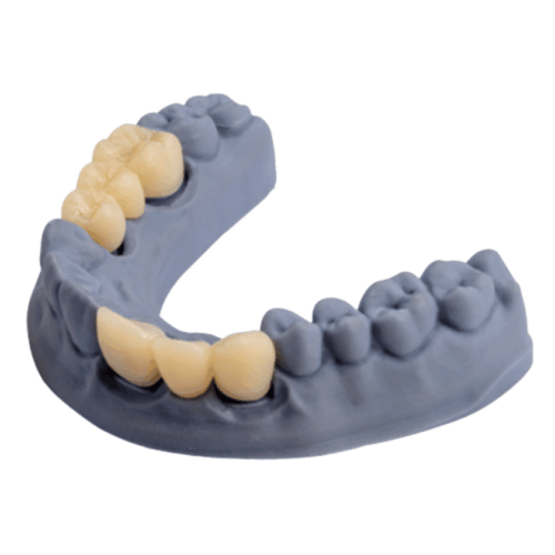 DTech Crown & Bridge