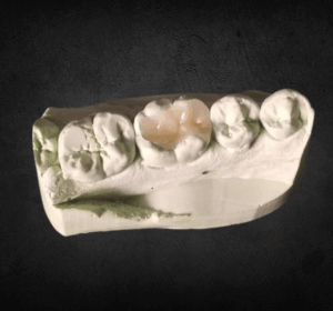 Inlay & Onlay betétek