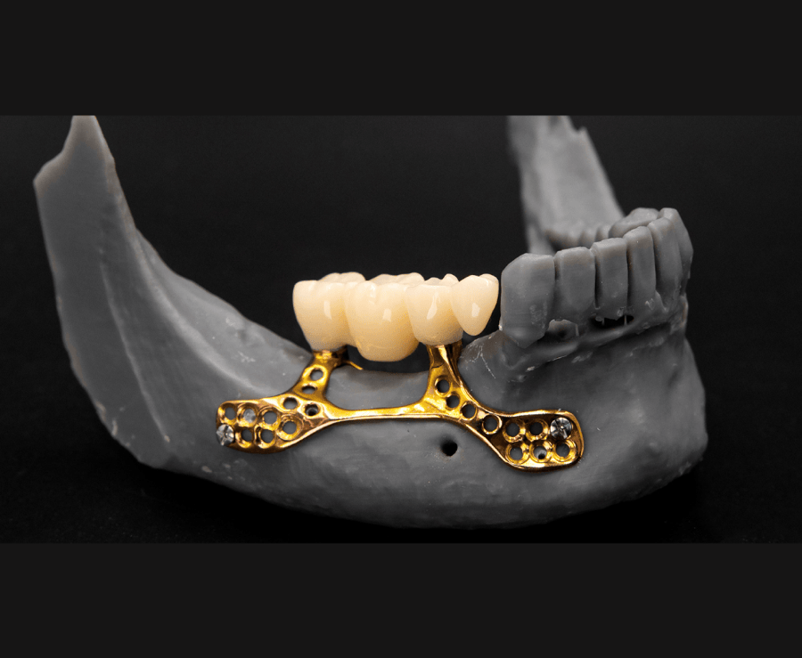 Subperiostealis implants