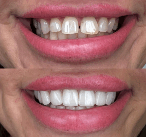 Teljes mosolyrehabilitáció